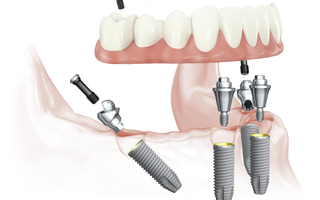3D render of an All-On-4 implant - helps if you are missing all your teeth.